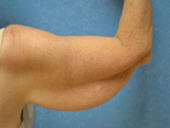 Arm Lift: BY1203 - Maumee, OH - Before