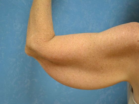 Arm Lift: BY1203 - Maumee, OH - Before