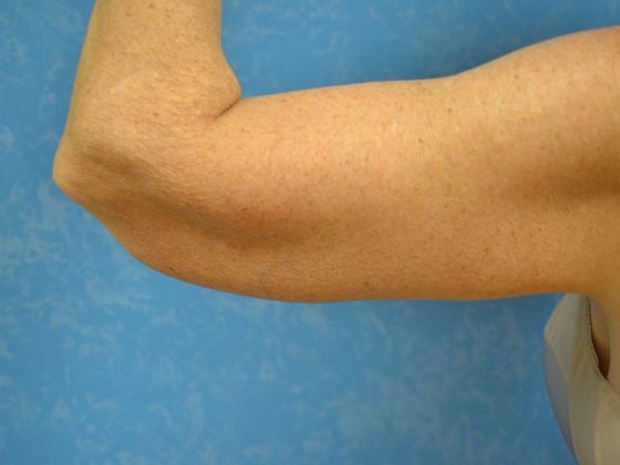 Arm Lift: BY1203 - Maumee, OH - After