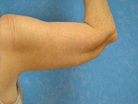 Arm Lift: BY1203 - Maumee, OH - After