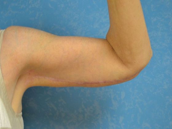 Arm Lift: BY1203 - Maumee, OH - After