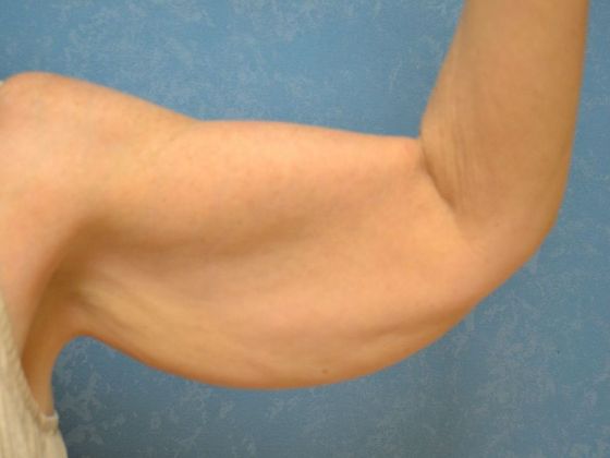 Arm Lift: BY1203 - Maumee, OH - Before