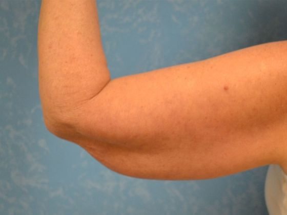 Arm Lift: BY1316 - Hamler, OH - Before