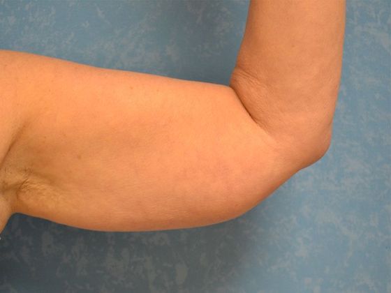 Arm Lift: BY1316 - Hamler, OH - Before