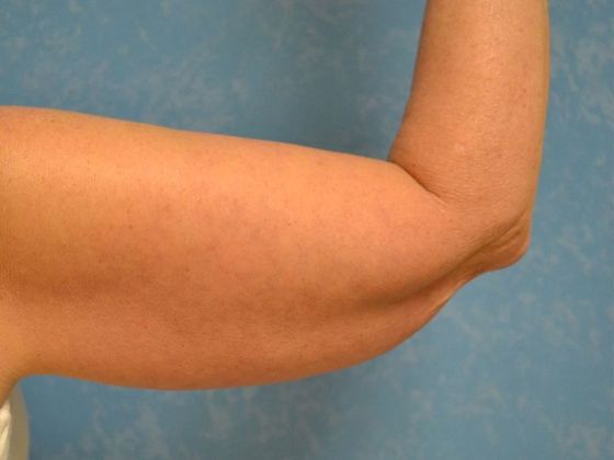 Arm Lift: BY1316 - Hamler, OH - Before