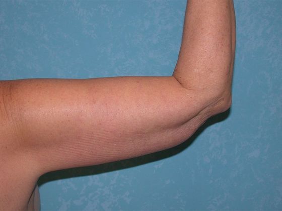 Arm Lift: BY1316 - Hamler, OH - After