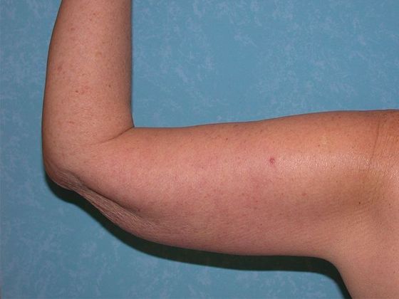 Arm Lift: BY1316 - Hamler, OH - After