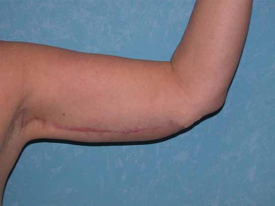 Arm Lift: BY1316 - Hamler, OH - After