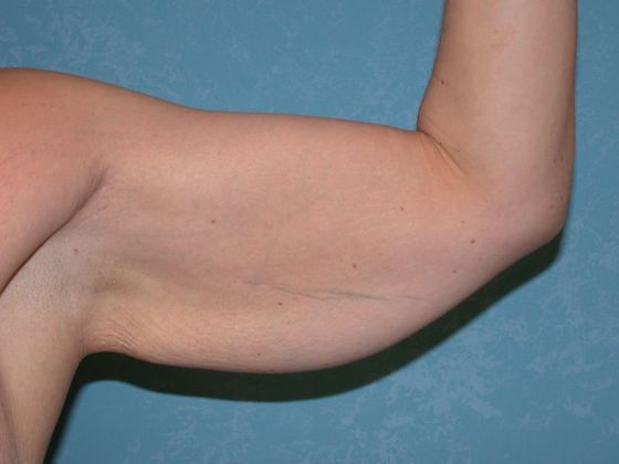 Arm Lift: BY1420 - Van Wert, OH - Before