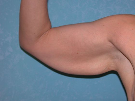 Arm Lift BY1420 - Van Wert, OH - Before