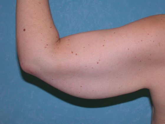 Arm Lift: BY1420 - Van Wert, OH - Before