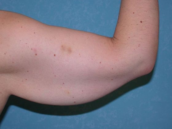 Arm Lift: BY1420 - Van Wert, OH - Before