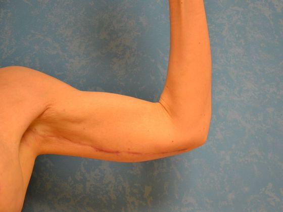 Arm Lift: BY1420 - Van Wert, OH - After