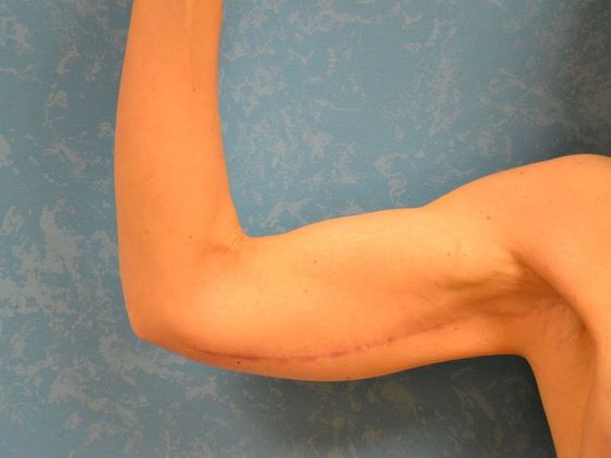 Arm Lift BY1420 - Van Wert, OH - After