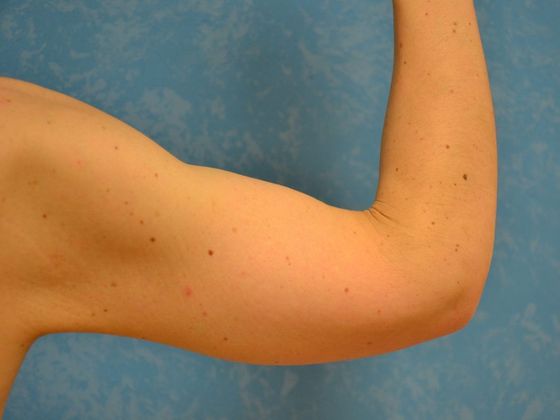 Arm Lift: BY1420 - Van Wert, OH - After