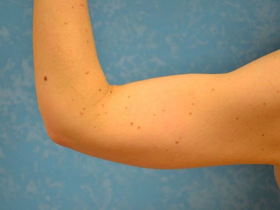 Arm Lift: BY1420 - Van Wert, OH - After