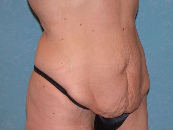 Bodylift: C1410 - Van Wert, OH - Before