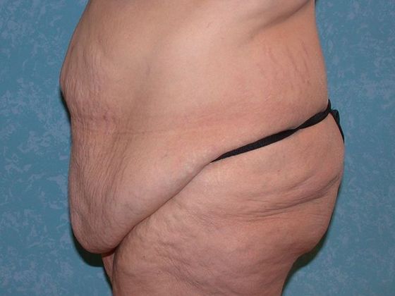 Bodylift: C1523 - Elmore, OH - Before