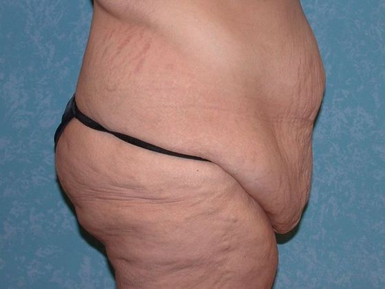 Bodylift: C1523 - Elmore, OH - Before