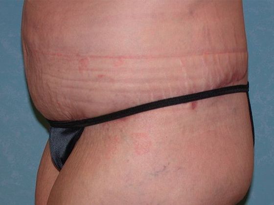 Bodylift: C1523 - Elmore, OH - After