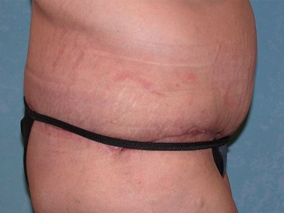 Bodylift: C1523 - Elmore, OH - After