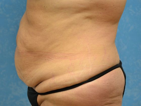 Bodylift: C1433 - Perrysburg, OH - Before