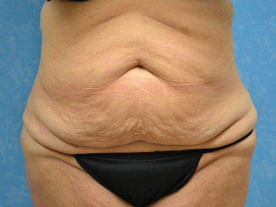 Bodylift C1433 - Perrysburg, OH - Before