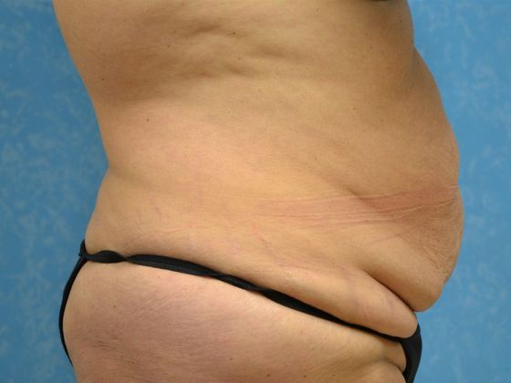 Bodylift: C1433 - Perrysburg, OH - Before