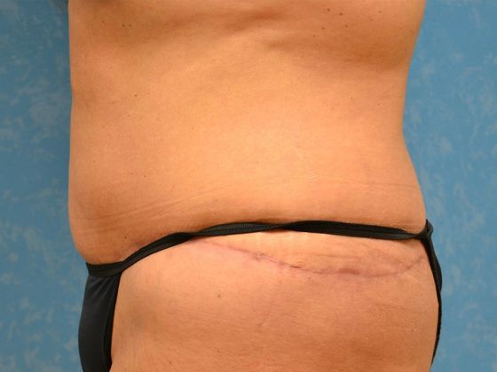 Bodylift: C1433 - Perrysburg, OH - After