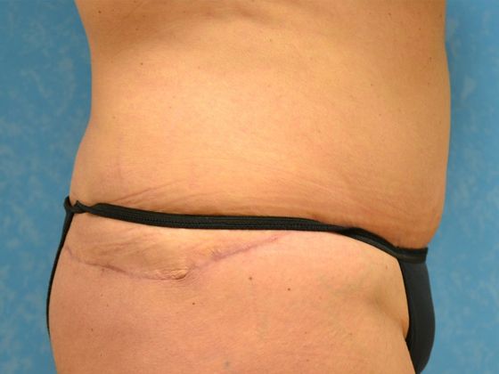 Bodylift: C1433 - Perrysburg, OH - After