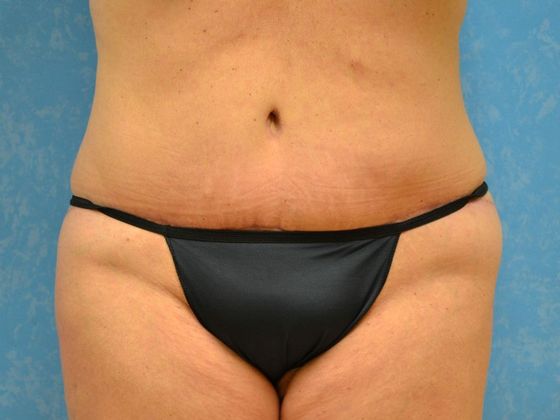 Bodylift C1433 - Perrysburg, OH - After