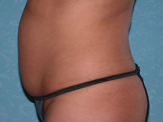 Liposuction: L1509 - Perrysburg, OH - Before