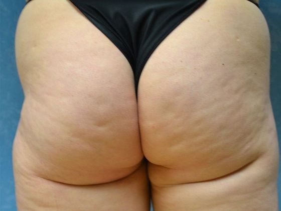 Liposuction: L1521 - Toledo, OH - Before