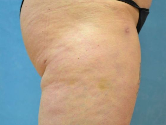 Liposuction: L1521 - Toledo, OH - Before