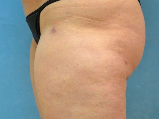 Liposuction: L1521 - Toledo, OH - Before