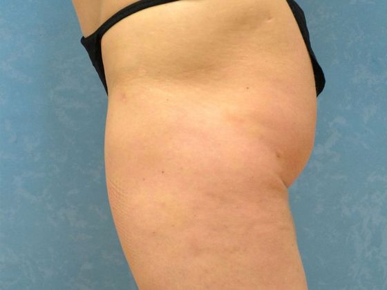 Liposuction: L1521 - Toledo, OH - After