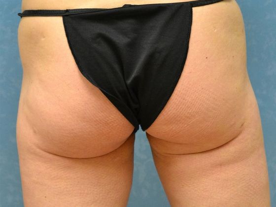 Liposuction: L1521 - Toledo, OH - After