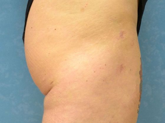 Liposuction: L1521 - Toledo, OH - After