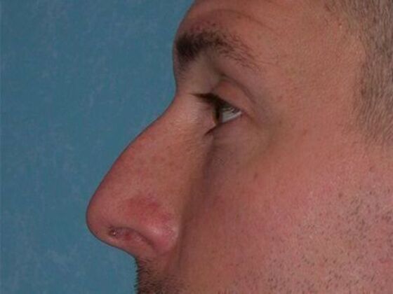 Rhinoplasty: RP1402 - Bowling Green, OH - Before