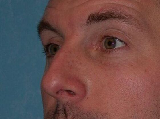 Rhinoplasty: RP1402 - Bowling Green, OH - Before