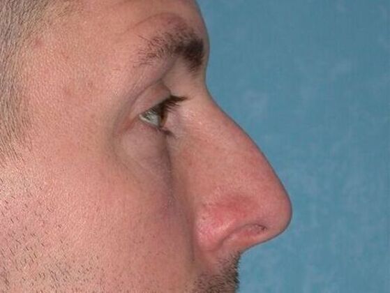 Rhinoplasty RP1402 - Bowling Green, OH - Before