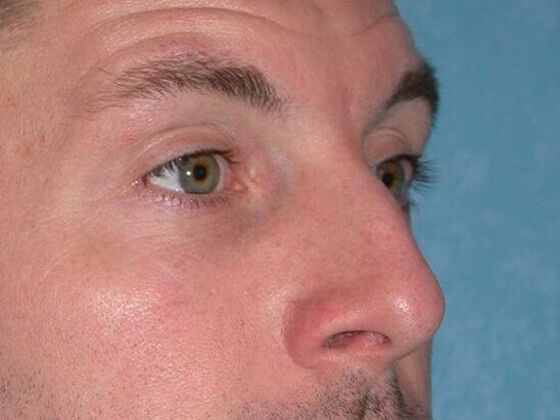 Rhinoplasty: RP1402 - Bowling Green, OH - Before