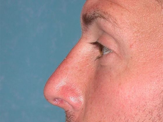 Rhinoplasty: RP1402 - Bowling Green, OH - After