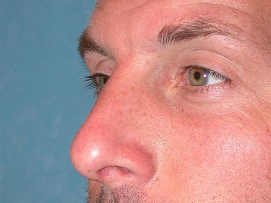 Rhinoplasty: RP1402 - Bowling Green, OH - After