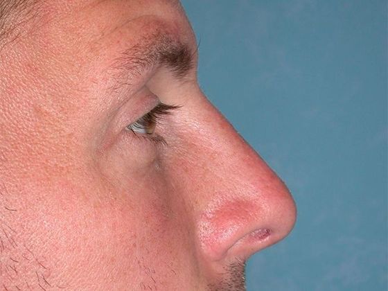 Rhinoplasty: RP1402 - Bowling Green, OH - After