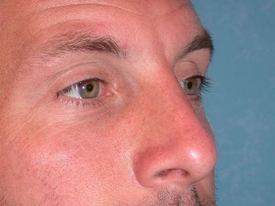 Rhinoplasty: RP1402 - Bowling Green, OH - After