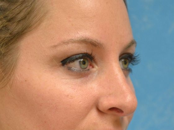 Rhinoplasty: RP1623 - Lima, OH - After