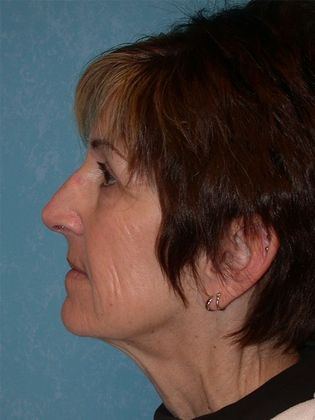 Face & Neck Lifts: FL1402 - Perrysburg, OH - Before