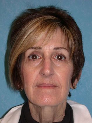 Face & Neck Lifts FL1402 - Perrysburg, OH - Before