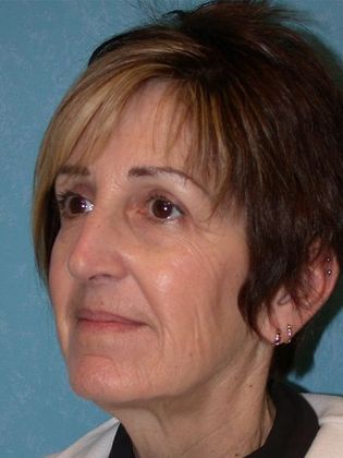 Face & Neck Lifts: FL1402 - Perrysburg, OH - Before